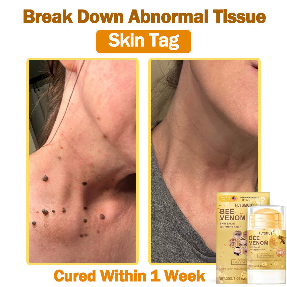 ❤️💞Flysmus™ Bee Venom Skin Salve Ointment Stick 𝐔𝐒 𝐃𝐞𝐫𝐦𝐚𝐭𝐨𝐥𝐨𝐠𝐢𝐬𝐭 𝐀𝐩𝐩𝐫𝐨𝐯𝐞𝐝(💞💞𝐀𝐀𝐃 𝐑𝐄𝐂𝐎𝐌𝐌𝐄𝐍𝐃𝐒)