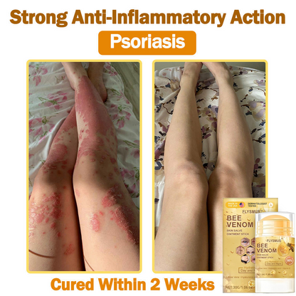 ❤️💞Flysmus™ Bee Venom Skin Salve Ointment Stick 𝐔𝐒 𝐃𝐞𝐫𝐦𝐚𝐭𝐨𝐥𝐨𝐠𝐢𝐬𝐭 𝐀𝐩𝐩𝐫𝐨𝐯𝐞𝐝(💞💞𝐀𝐀𝐃 𝐑𝐄𝐂𝐎𝐌𝐌𝐄𝐍𝐃𝐒)