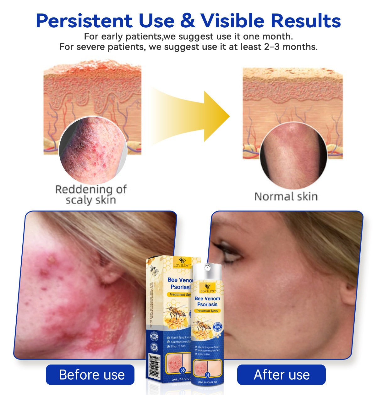 ✅ Official store: 🐝LOVILDS™PsoriaHeal psoriasis Spray 🐝✨👨‍⚕️ Approved by the American Association of Dermatology (AAOS) (for itchy skin, dry, itchy, redness, scales, eczema, rash, skin inflammation, etc.)