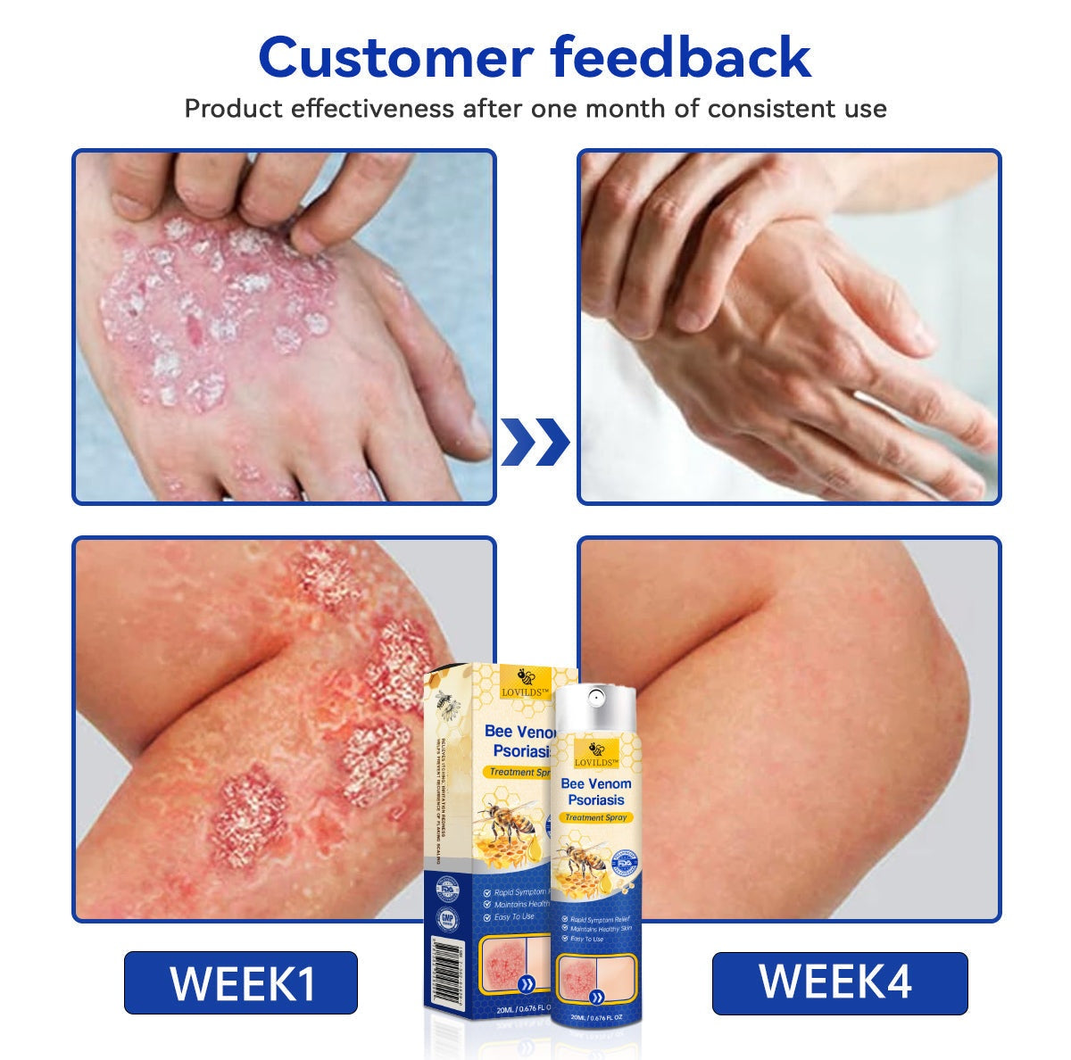 ✅ Official store: 🐝LOVILDS™PsoriaHeal psoriasis Spray 🐝✨👨‍⚕️ Approved by the American Association of Dermatology (AAOS) (for itchy skin, dry, itchy, redness, scales, eczema, rash, skin inflammation, etc.)