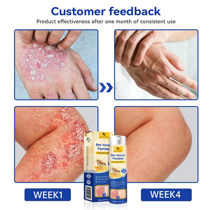 ✅ Official store: 🐝LOVILDS™PsoriaHeal psoriasis Spray 🐝✨👨‍⚕️ Approved by the American Association of Dermatology (AAOS) (for itchy skin, dry, itchy, redness, scales, eczema, rash, skin inflammation, etc.)