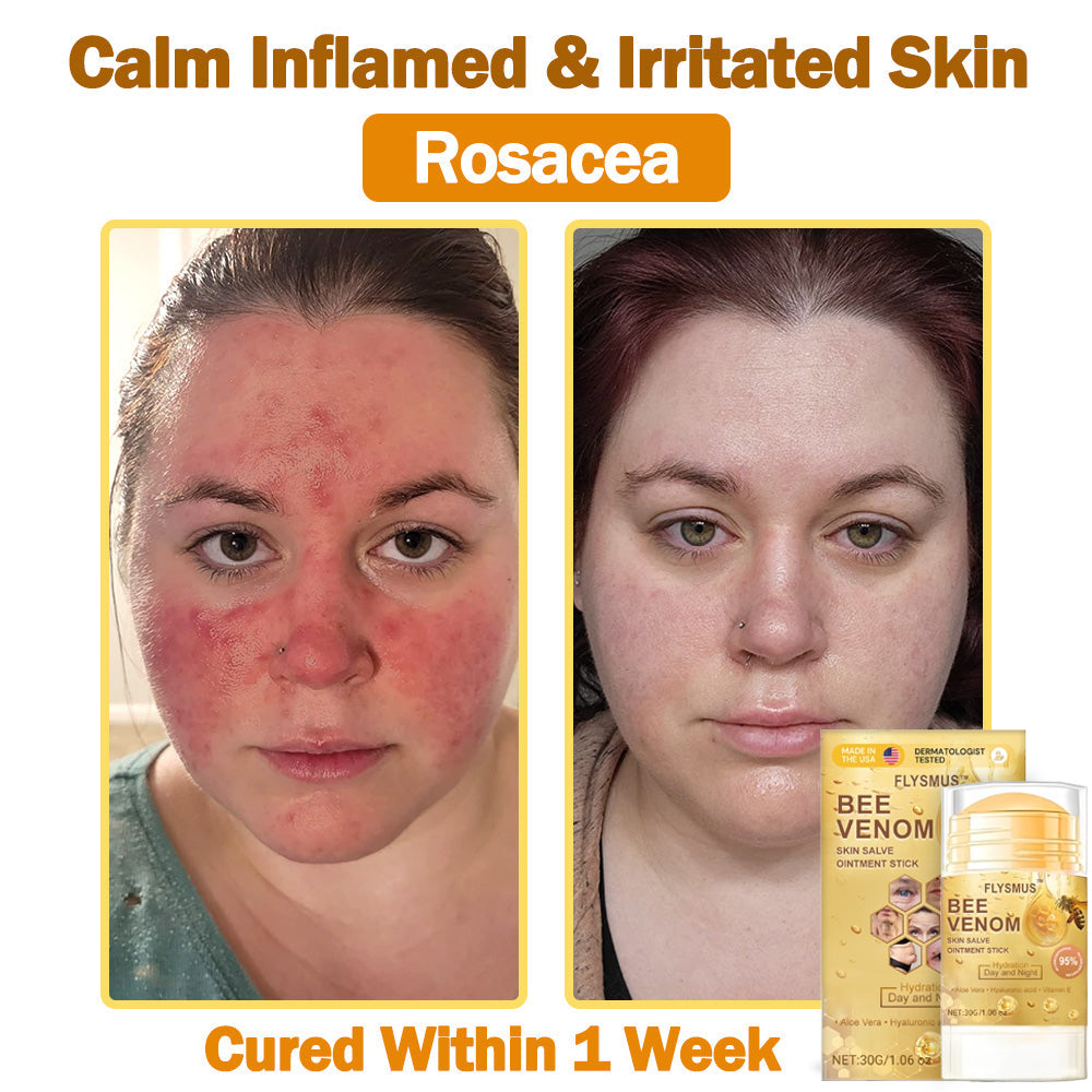 ❤️💞Flysmus™ Bee Venom Skin Salve Ointment Stick 𝐔𝐒 𝐃𝐞𝐫𝐦𝐚𝐭𝐨𝐥𝐨𝐠𝐢𝐬𝐭 𝐀𝐩𝐩𝐫𝐨𝐯𝐞𝐝(💞💞𝐀𝐀𝐃 𝐑𝐄𝐂𝐎𝐌𝐌𝐄𝐍𝐃𝐒)