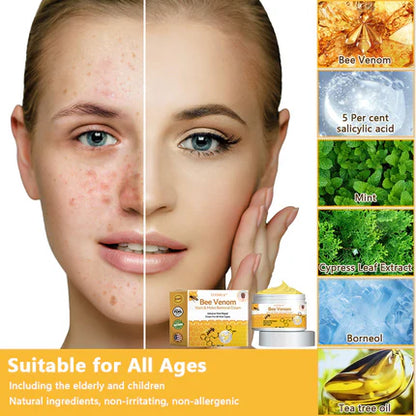 ✨Flysmus™ Bee Venom Wart and Moles Removal Cream (Last day offer, 80% discount)