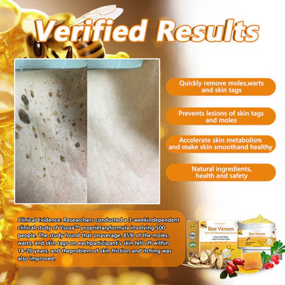 ✨Flysmus™ Bee Venom Wart and Moles Removal Cream (Last day offer, 80% discount)