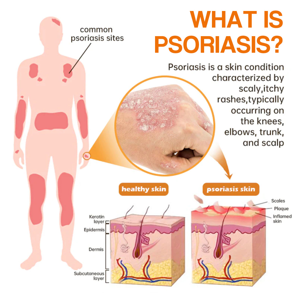 ✅ Official store: 🐝LOVILDS™PsoriaHeal psoriasis Spray 🐝✨👨‍⚕️ Approved by the American Association of Dermatology (AAOS) (for itchy skin, dry, itchy, redness, scales, eczema, rash, skin inflammation, etc.)