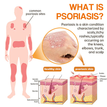 ✅ Official store: 🐝LOVILDS™PsoriaHeal psoriasis Spray 🐝✨👨‍⚕️ Approved by the American Association of Dermatology (AAOS) (for itchy skin, dry, itchy, redness, scales, eczema, rash, skin inflammation, etc.)