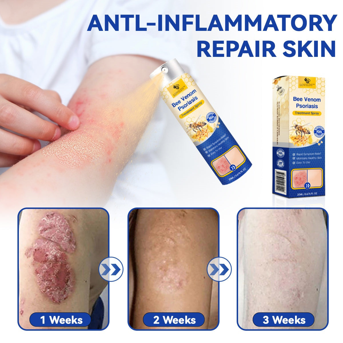 ✅ Official store: 🐝LOVILDS™PsoriaHeal psoriasis Spray 🐝✨👨‍⚕️ Approved by the American Association of Dermatology (AAOS) (for itchy skin, dry, itchy, redness, scales, eczema, rash, skin inflammation, etc.)