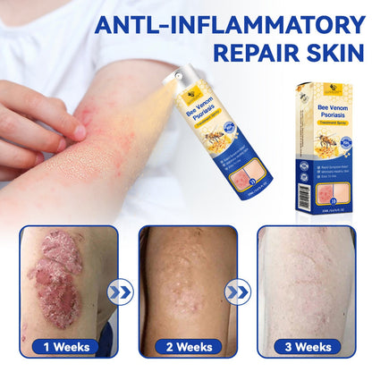 ✅ Official store: 🐝LOVILDS™PsoriaHeal psoriasis Spray 🐝✨👨‍⚕️ Approved by the American Association of Dermatology (AAOS) (for itchy skin, dry, itchy, redness, scales, eczema, rash, skin inflammation, etc.)