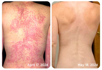 ✅ Official store: 🐝LOVILDS™PsoriaHeal psoriasis Spray 🐝✨👨‍⚕️ Approved by the American Association of Dermatology (AAOS) (for itchy skin, dry, itchy, redness, scales, eczema, rash, skin inflammation, etc.)