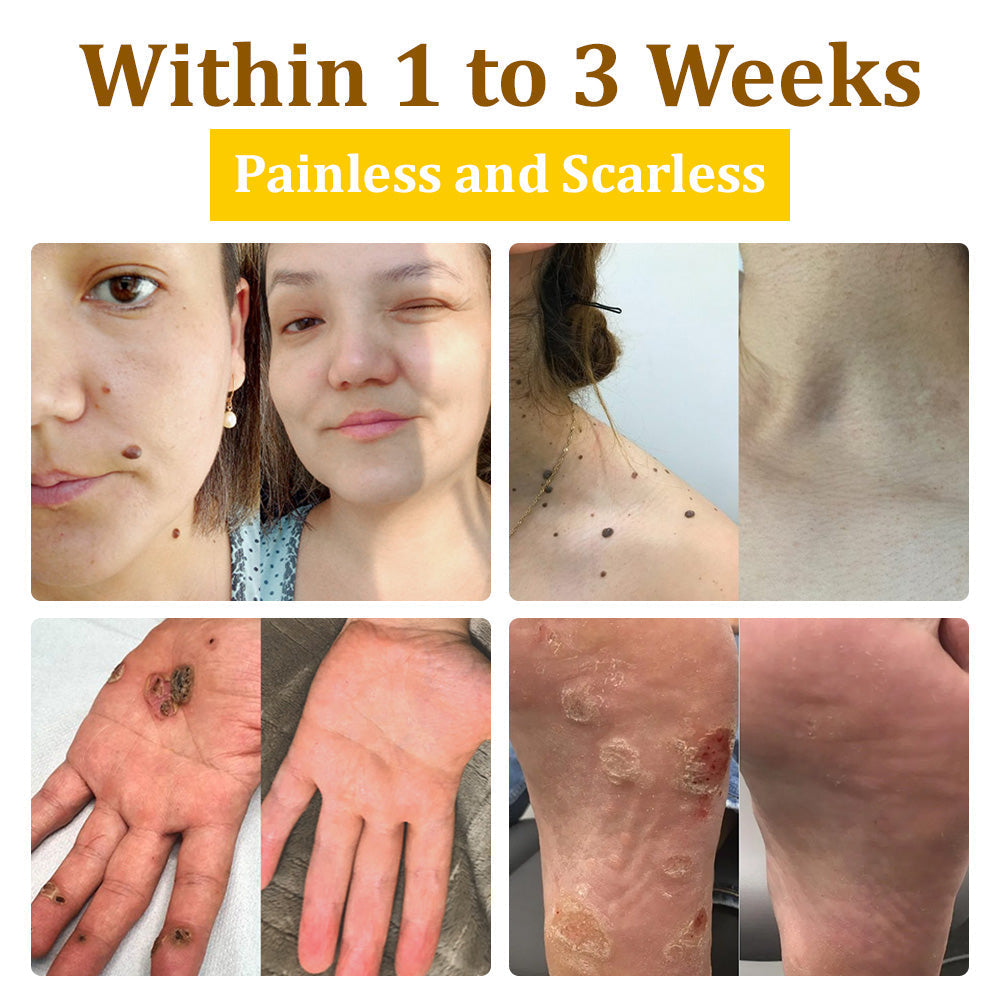 🏆✅flysmus™ Bee Venom Treatment Cream🐝: Helps with Eczema, Psoriasis, Acne, Rosacea, Fungal Infections, and Warts