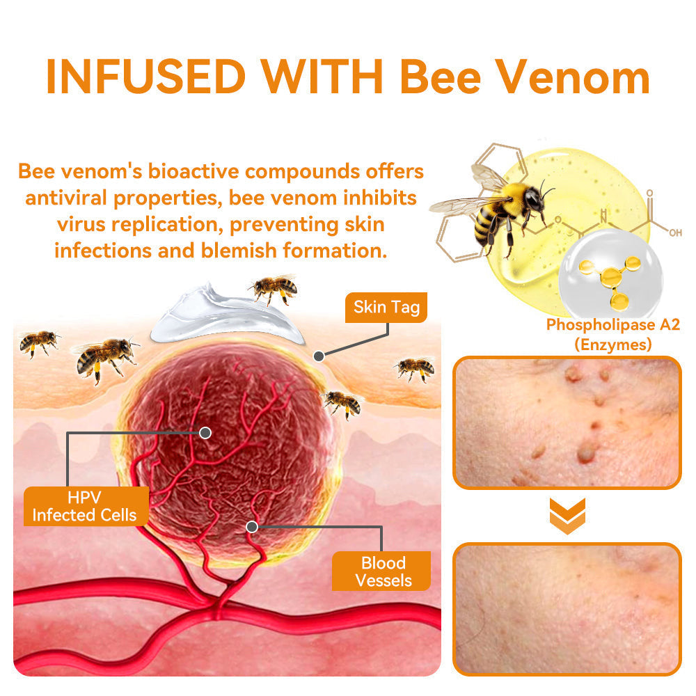 ✨Flysmus™ Bee Venom Wart and Moles Removal Cream (Last day offer, 80% discount)