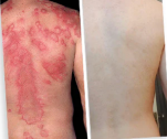 ✅ Official store: 🐝LOVILDS™PsoriaHeal psoriasis Spray 🐝✨👨‍⚕️ Approved by the American Association of Dermatology (AAOS) (for itchy skin, dry, itchy, redness, scales, eczema, rash, skin inflammation, etc.)