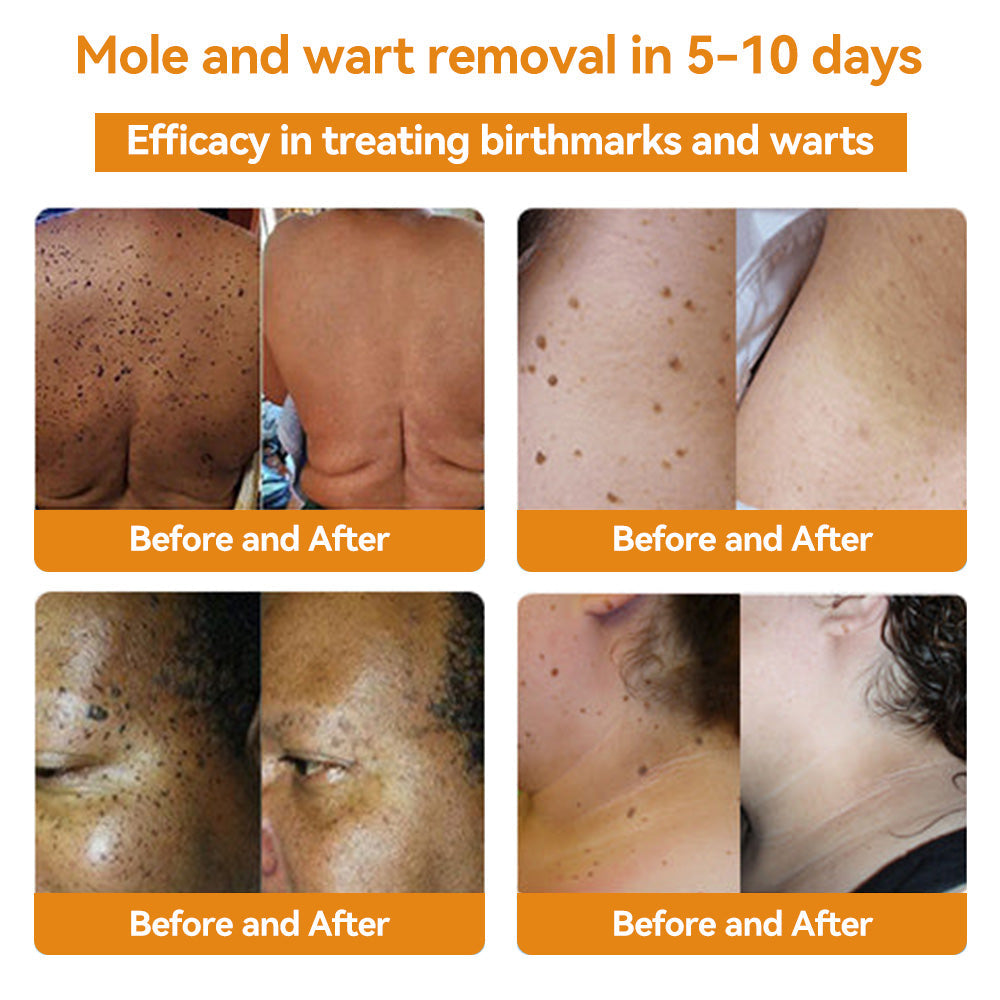✨Flysmus™ Bee Venom Wart and Moles Removal Cream (Last day offer, 80% discount)