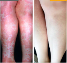 ✅ Official store: 🐝LOVILDS™PsoriaHeal psoriasis Spray 🐝✨👨‍⚕️ Approved by the American Association of Dermatology (AAOS) (for itchy skin, dry, itchy, redness, scales, eczema, rash, skin inflammation, etc.)