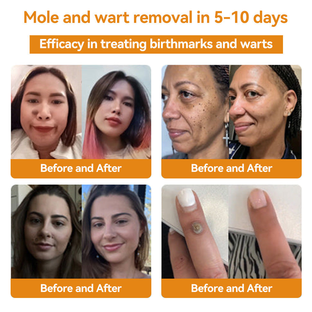 ✨Flysmus™ Bee Venom Wart and Moles Removal Cream (Last day offer, 80% discount)