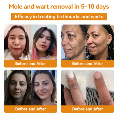 ✨Flysmus™ Bee Venom Wart and Moles Removal Cream (Last day offer, 80% discount)