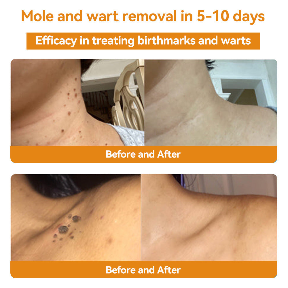 ✨Flysmus™ Bee Venom Wart and Moles Removal Cream (Last day offer, 80% discount)