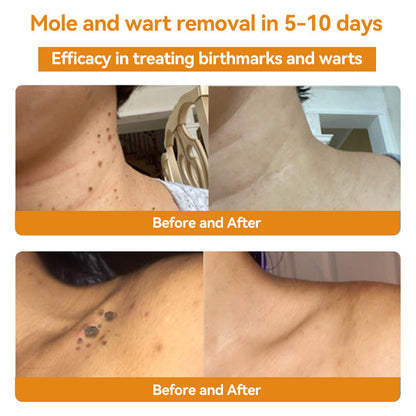 ✨Flysmus™ Bee Venom Wart and Moles Removal Cream (Last day offer, 80% discount)