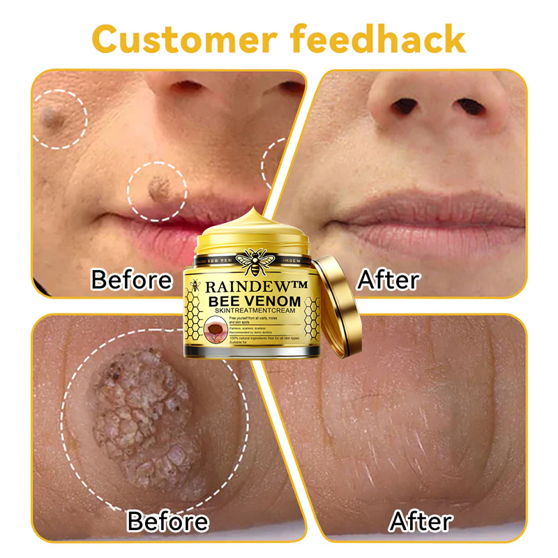 ✅ Official Store: [Winter-Skincare] Flysmus™ Bee Venom Skin Treatment Cream（Meets AAD Standards）🧑‍⚕️