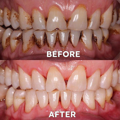 Official Store | ✨Ourlyard™ Tooth Health Mineral Powder - ✅FDA-Approved