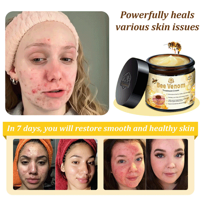 🌟👍Official Store: Flysmus™ Bee Venom Skin Treatment Cream👨‍⚕️American Academy of Dermatology (AAD) Approved.