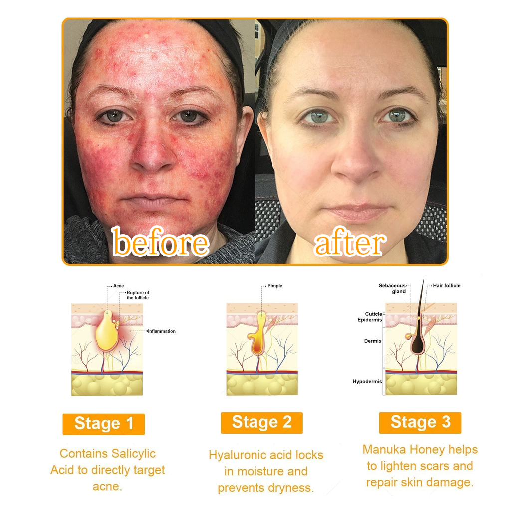 ✅ Official store: 🐝LOVILDS™PsoriaHeal psoriasis Spray 🐝✨👨‍⚕️ Approved by the American Association of Dermatology (AAOS) (for itchy skin, dry, itchy, redness, scales, eczema, rash, skin inflammation, etc.)