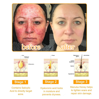 ✅ Official store: 🐝LOVILDS™PsoriaHeal psoriasis Spray 🐝✨👨‍⚕️ Approved by the American Association of Dermatology (AAOS) (for itchy skin, dry, itchy, redness, scales, eczema, rash, skin inflammation, etc.)
