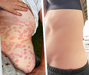 ✅ Official store: 🐝LOVILDS™PsoriaHeal psoriasis Spray 🐝✨👨‍⚕️ Approved by the American Association of Dermatology (AAOS) (for itchy skin, dry, itchy, redness, scales, eczema, rash, skin inflammation, etc.)