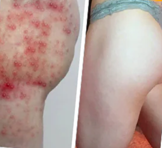 ✅ Official store: 🐝LOVILDS™PsoriaHeal psoriasis Spray 🐝✨👨‍⚕️ Approved by the American Association of Dermatology (AAOS) (for itchy skin, dry, itchy, redness, scales, eczema, rash, skin inflammation, etc.)