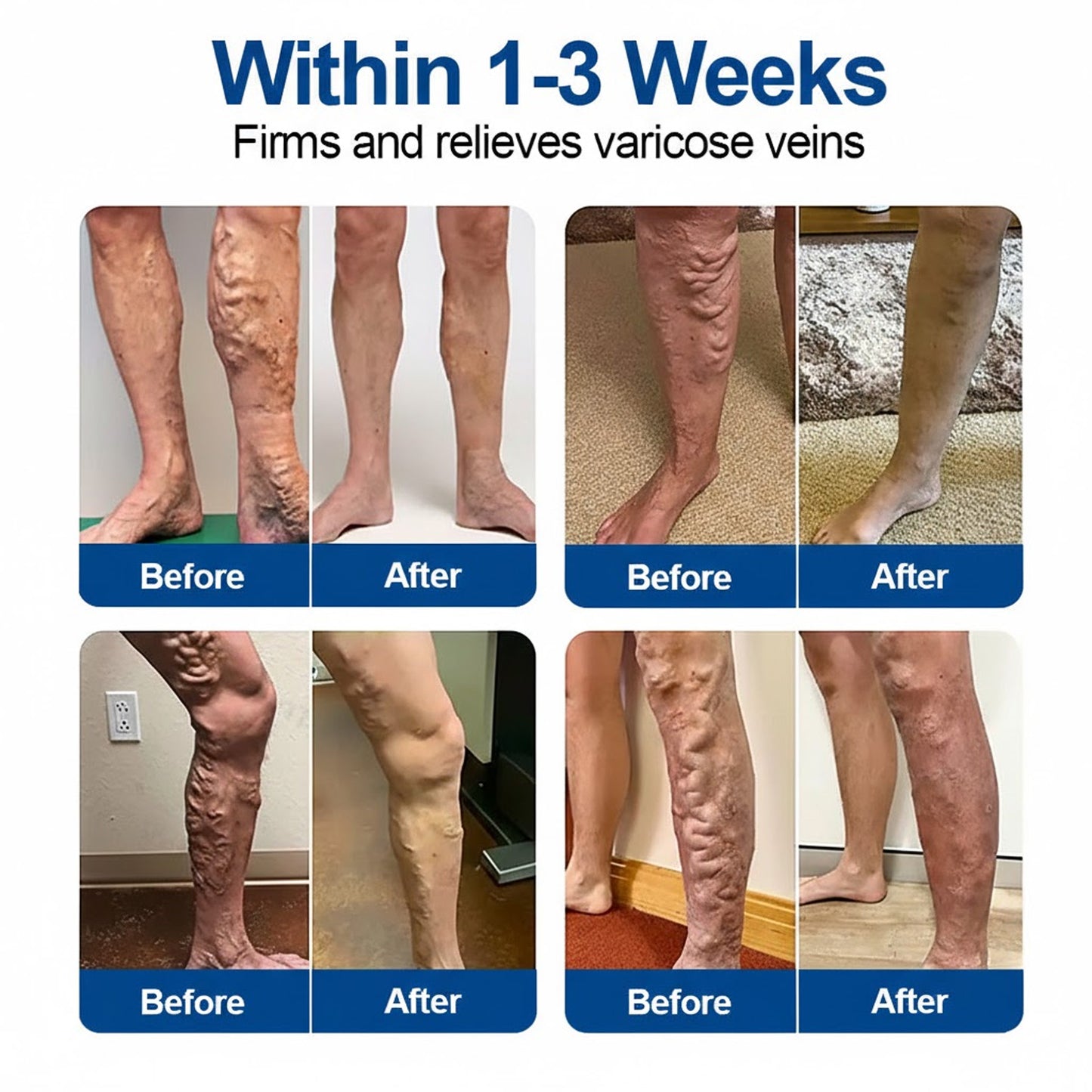 🇨🇦👨‍⚕️🔥GFOUK® VeinEase Microneedle Care Patch⚡Instant Relief, Long-Term Results