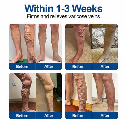 🇨🇦👨‍⚕️🔥GFOUK® VeinEase Microneedle Care Patch⚡Instant Relief, Long-Term Results