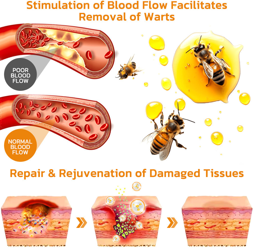 ✨Flysmus™ Bee Venom Wart and Moles Removal Cream (Last day offer, 80% discount)