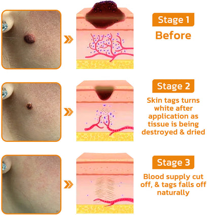 ✨Flysmus™ Bee Venom Wart and Moles Removal Cream (Last day offer, 80% discount)