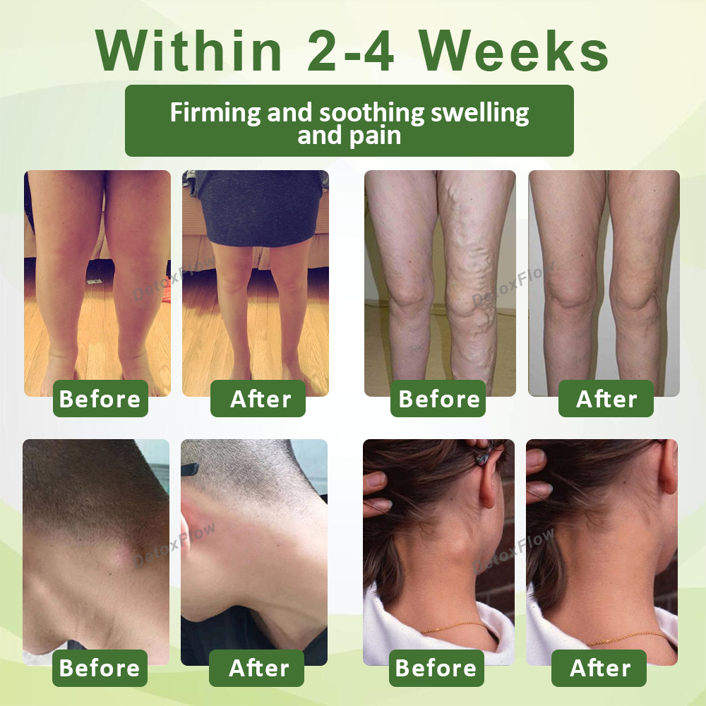 🧨Furzero™ SwellFree Lymphatic Herbal Cream