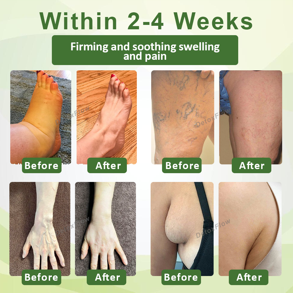 🧨Furzero™ SwellFree Lymphatic Herbal Cream