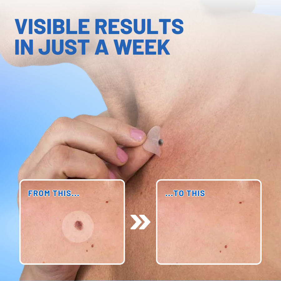 Flysmus™ Moles & Warts Removing Skin Tag Patch