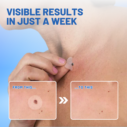 Flysmus™ Moles & Warts Removing Skin Tag Patch