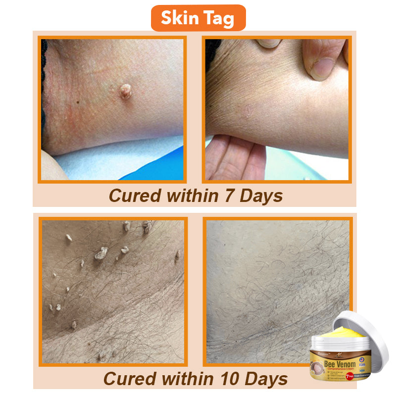 ✨🐝 flysmus™ Bee Venom Comprehensive Cream 🇺🇸 Dermatologist Recommended