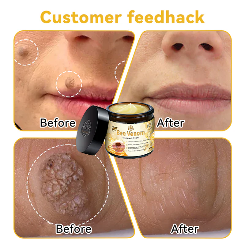 🌟👍Official Store: Flysmus™ Bee Venom Skin Treatment Cream👨‍⚕️American Academy of Dermatology (AAD) Approved.