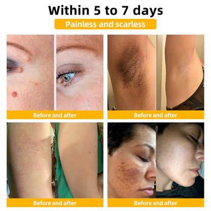 ✨✨Turonu™ Bee Venom Skin Treatment Cream（𝐴𝐴𝐷 𝑅𝑒𝑐𝑜𝑚𝑚𝑒𝑛𝑑𝑒𝑑）