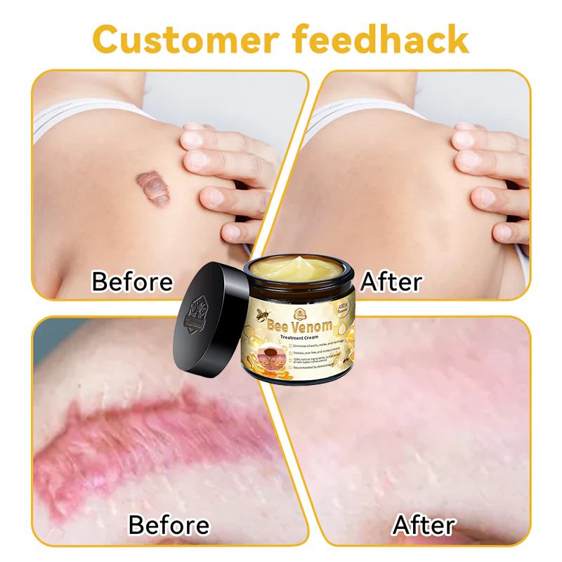 ✨✨Turonu™ Bee Venom Skin Treatment Cream（𝐴𝐴𝐷 𝑅𝑒𝑐𝑜𝑚𝑚𝑒𝑛𝑑𝑒𝑑）